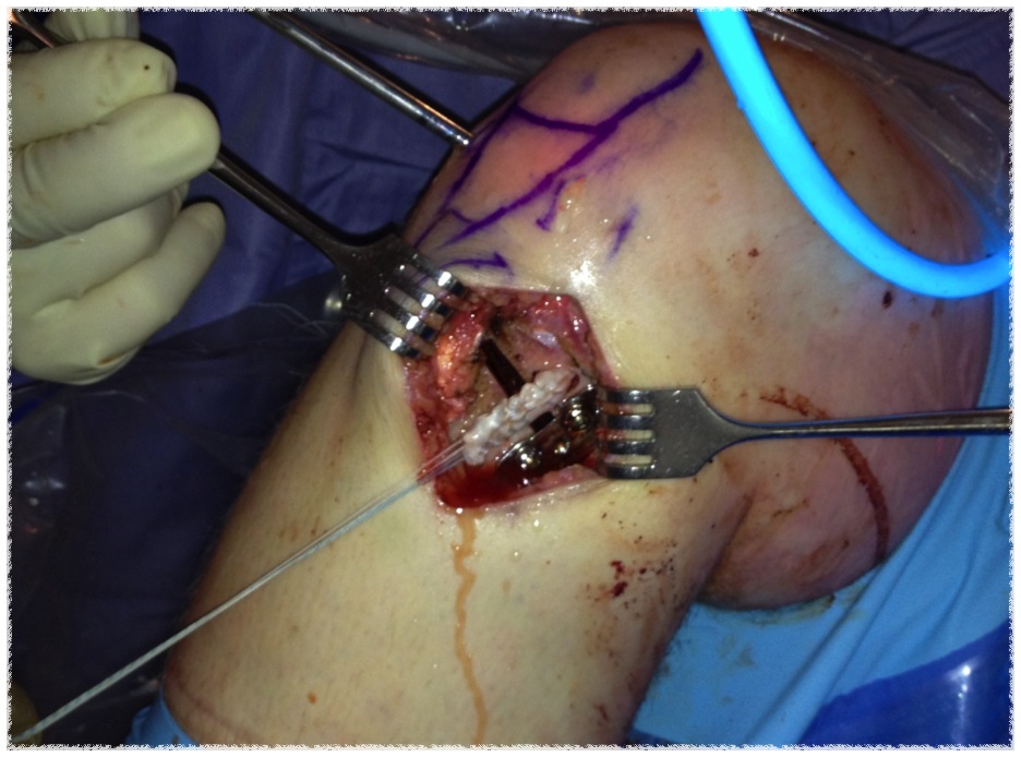 ACL HTO Intraoperative